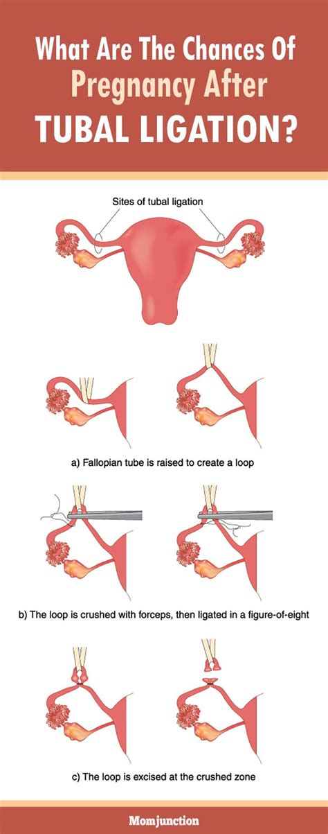 what are the odds of getting pregnant after tubal ligation|Pregnancy After Tubal Ligation: Signs to Know .